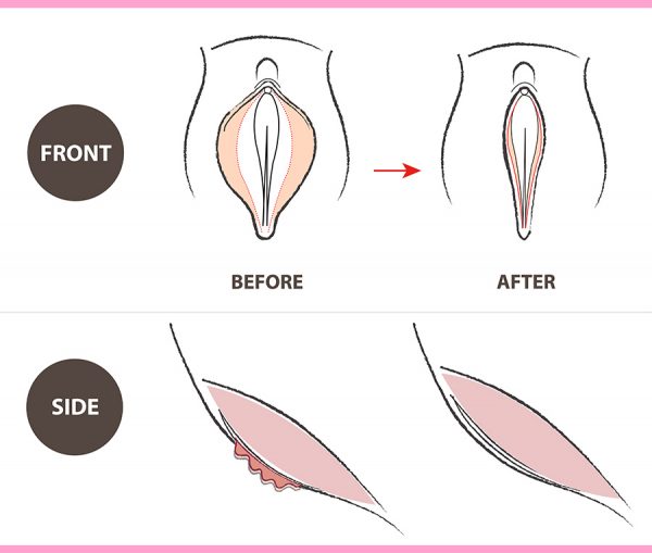 Medical illustration of labial reduction, showing front and side views before and after